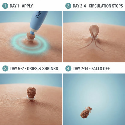 Painless Skin Tag Removal Kit